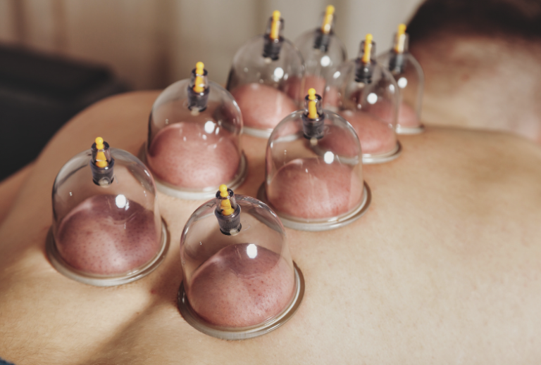 cupping