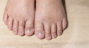 lipoedema treatment